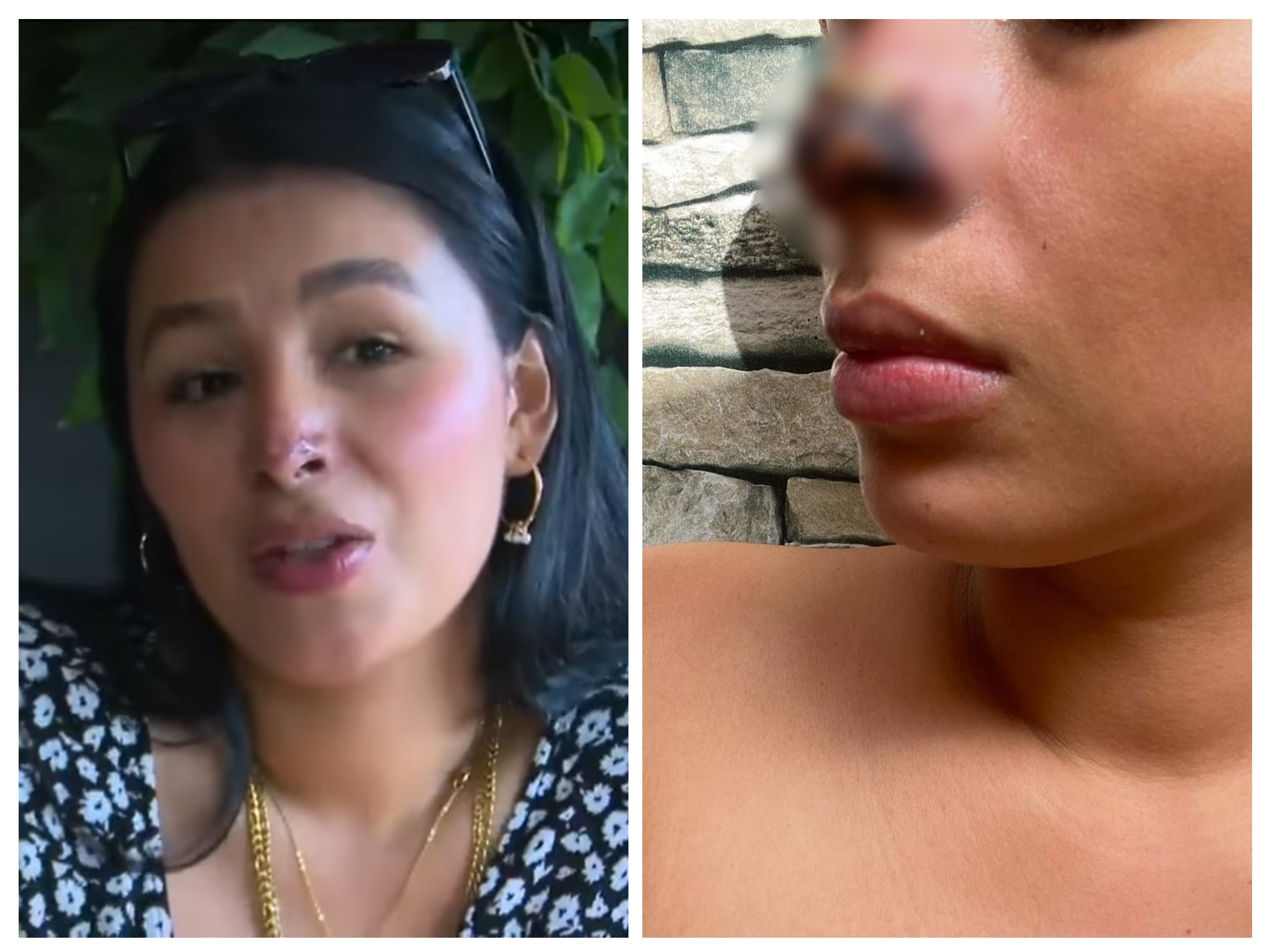 Joven de Minatitlán casi pierde su nariz tras una cirugía estética